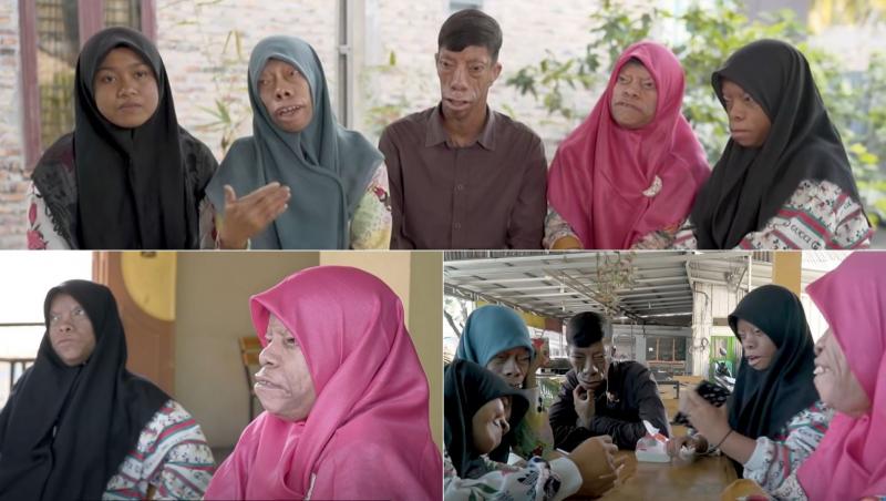 O familie din Sumatra de Nord, Indonezia, trăiește cu o afecțiune rară care face ca fețele lor să își schimbe forma. Din cei șase copii ai familiei Manurung, patru dintre ei trăiesc cu o afecțiune facială nediagnosticată și incredibil de rară.
