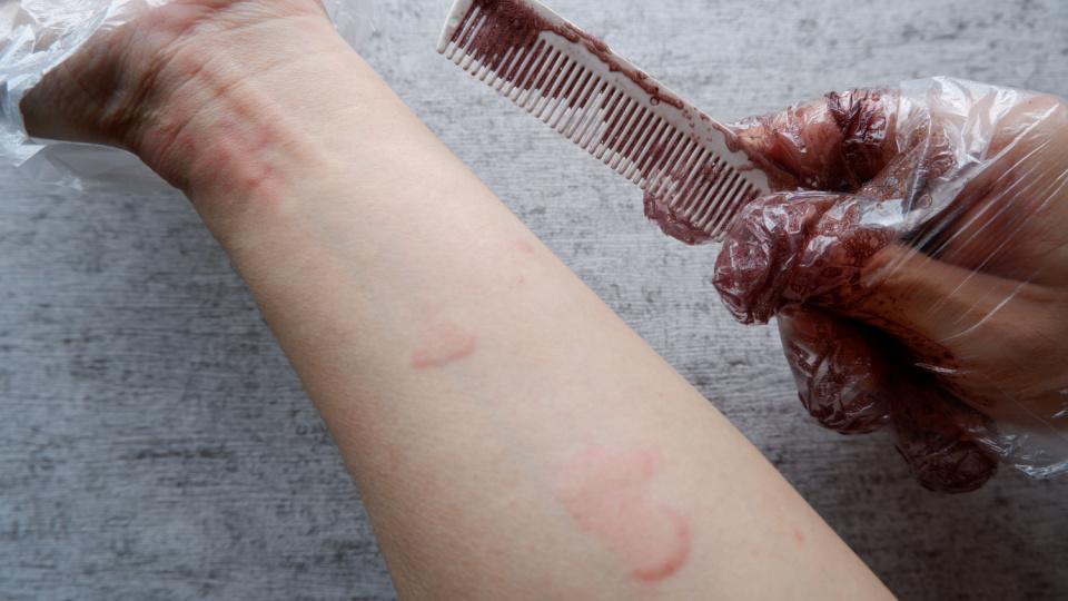 Reacție alergică în locurile în care vopseaua a atins pielea din zona mâinii