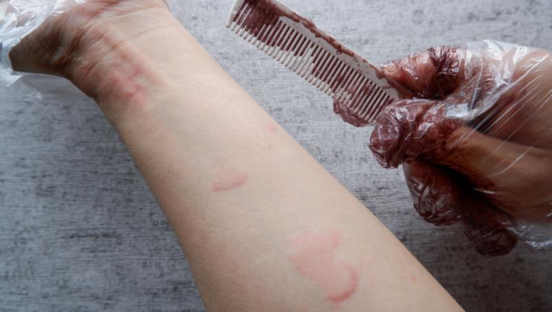 Reacție alergică în locurile în care vopseaua a atins pielea din zona mâinii
