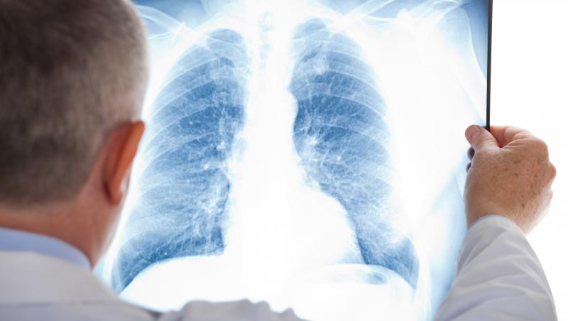 Medicul verifică o radiografie la plămâni