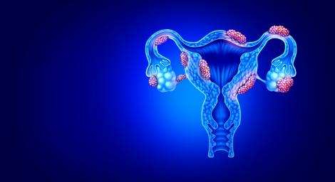 (P) Ce este endometrioza, cât de gravă este afecțiunea și care sunt complicațiile posibile?