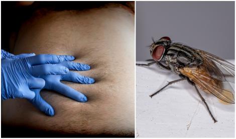 Un medic a descoperit în intestinul unui pacient o muscă intactă, în timp ce efectua o colonoscopie. Ce s-a aflat