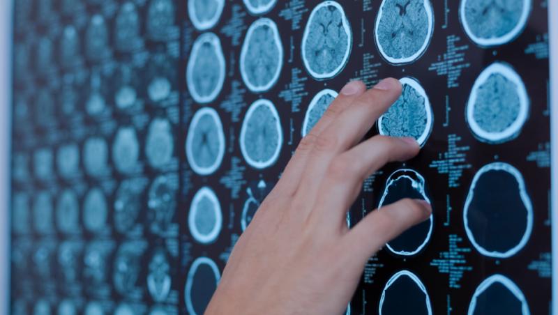 Imagine cu o radiografie a creierului unui om care se confruntă cu probleme din cauza băuturilor toxice.