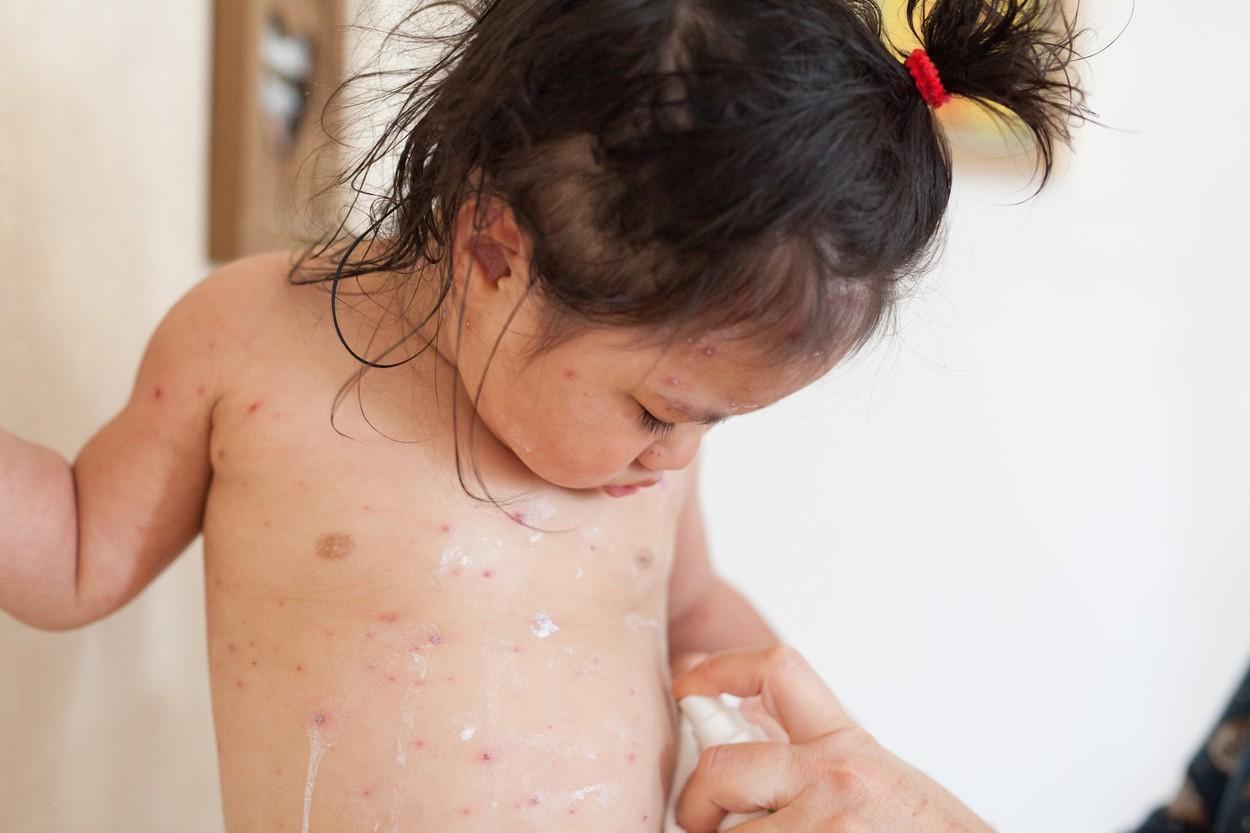 O fetiță a luat varicelă de la grădiniță și în scurt timp a ajuns de urgență la spital. Medicii i-au pus un diagnostic crunt