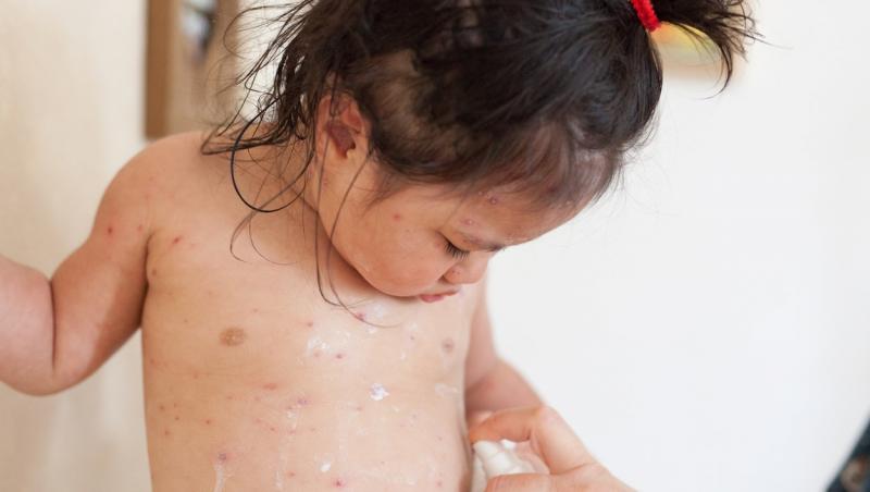Copila a avut de suferit de pe urma complicațiilor date de varicelă