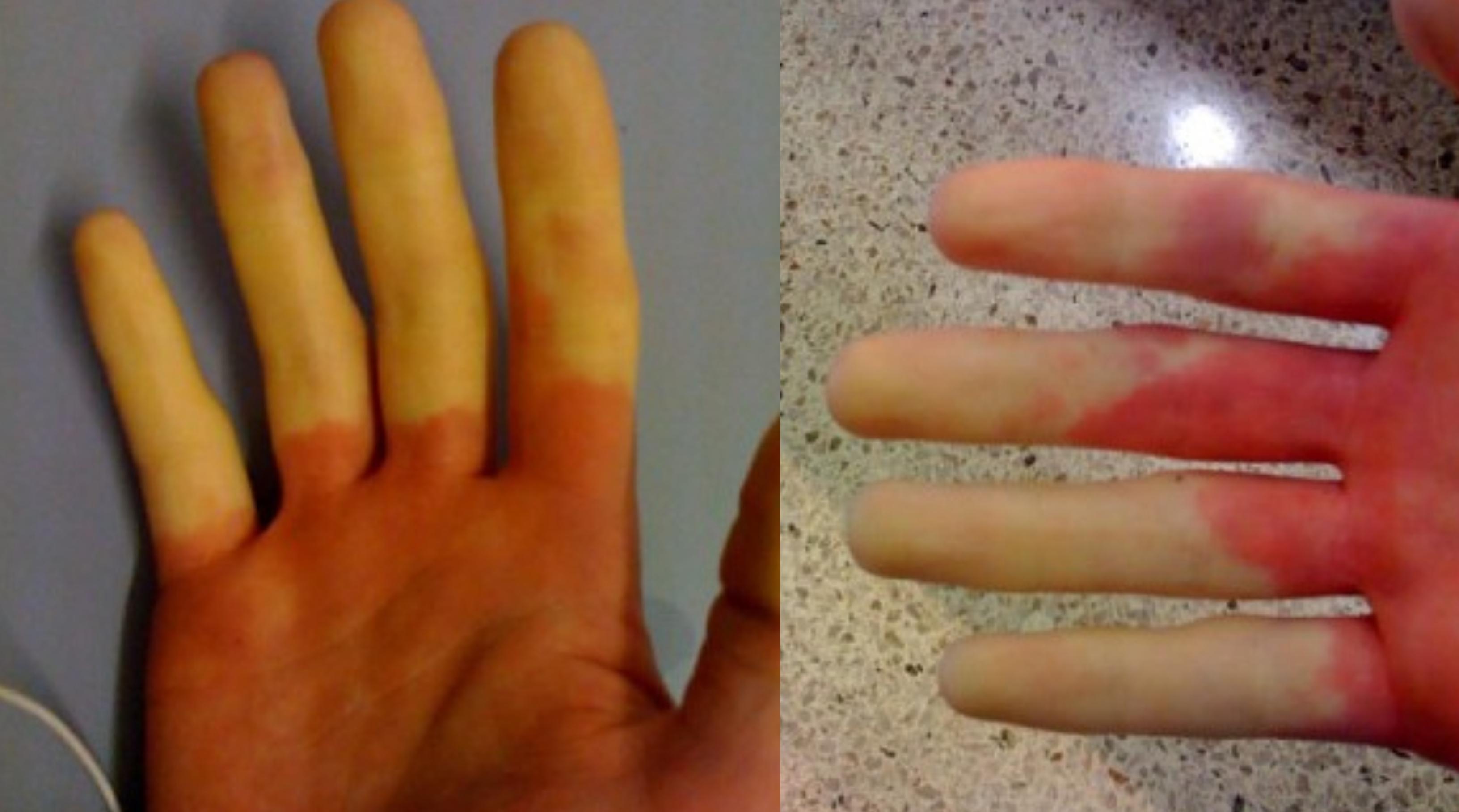 O femeie și-a pozat degetele colorate diferit: așa arăta în dimineața asta. Ce a pățit și ce înseamnă de fapt