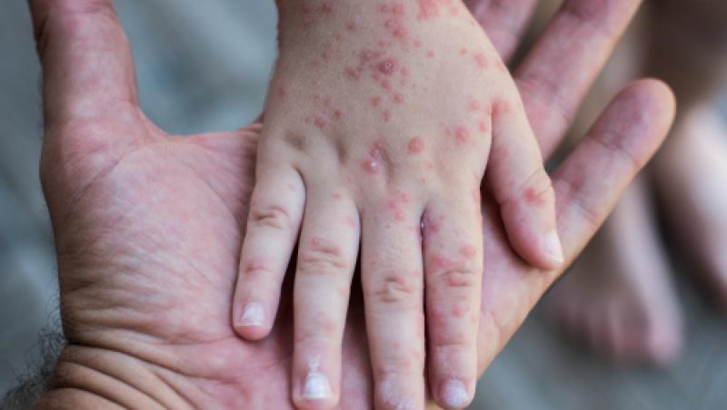 Ministerul Sănătății a declarat epidemie de rujeolă la nivel național. Câte cazuri se înregistrează pe teritorul României