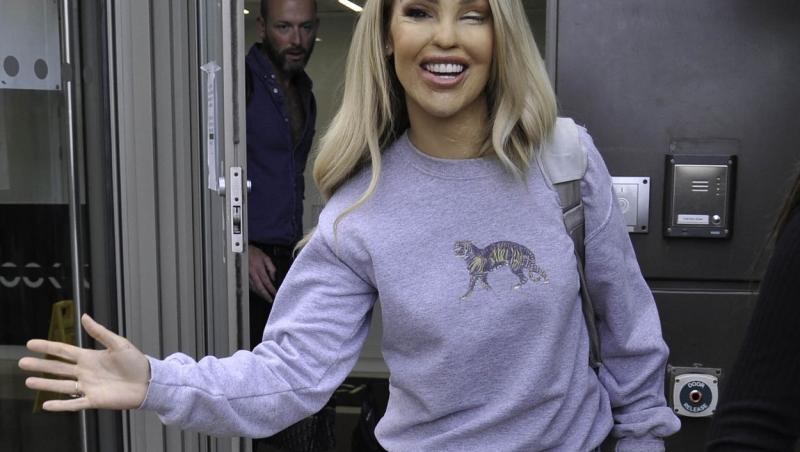 Femeia desfigurată de iubit cu acid, complicații după 400 de operații și 15 ani de chin. Ce a pățit Katie Piper recent