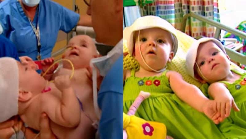 În 2003, când aveau doar 10 luni de viață, Mackenzie și Macey erau supuse unei intervenții care le-a despărțit trupurile. Iată cum arată acum cele două tinere.