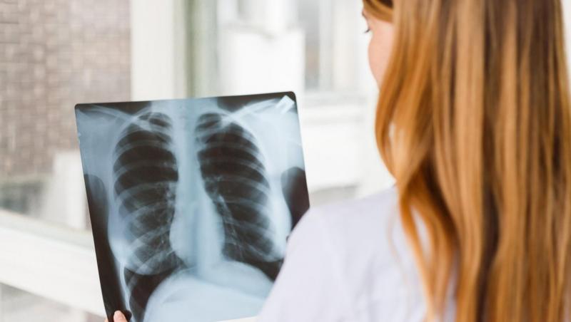 un medic care se uită la radiografia unor plămâni