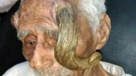 „Bărbatul cu coarne”, considerat cel mai bătrân om din lume, a murit la vârsta de 140 de ani. Care e motivul pentru care arăta așa