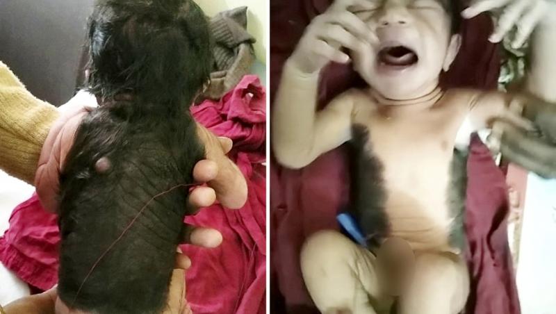 Un bebeluș s-a născut, spre surprinderea medicilor, cu spatele acoperit de o pată neagră și păr. Ce sunt semnele de pe piele