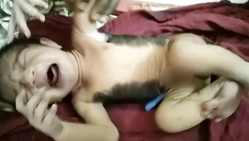 Un bebeluș s-a născut, spre surprinderea medicilor, cu spatele acoperit de o pată neagră și păr. Ce sunt semnele de pe piele