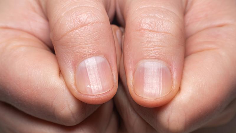 Descoperă ce înseamnă dacă ai aceste semne pe unghii
