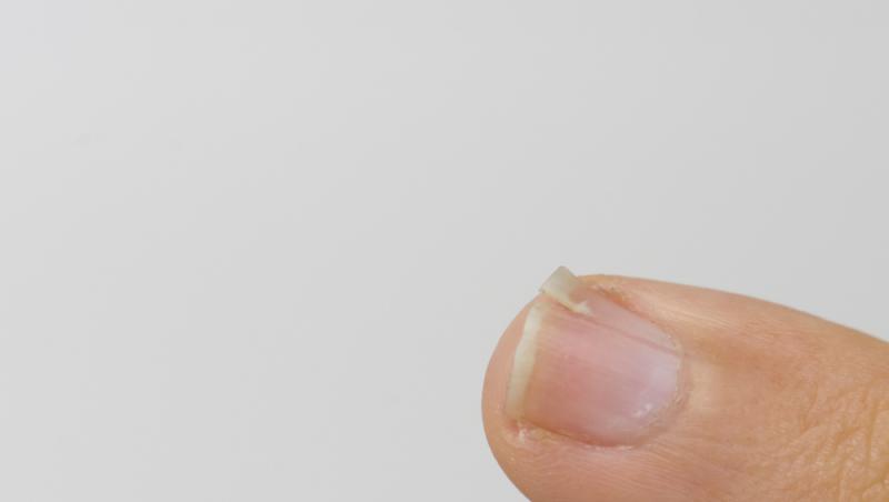 Semnul de pe unghie ce te trimite urgent la doctor. Ce înseamnă dacă îl ai și la ce ar trebui să te aștepți