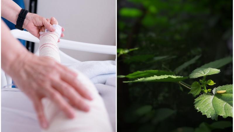colaj foto cu un picior bandajat si poza cu cea mai periculoasa planta din lume, urzica australiana