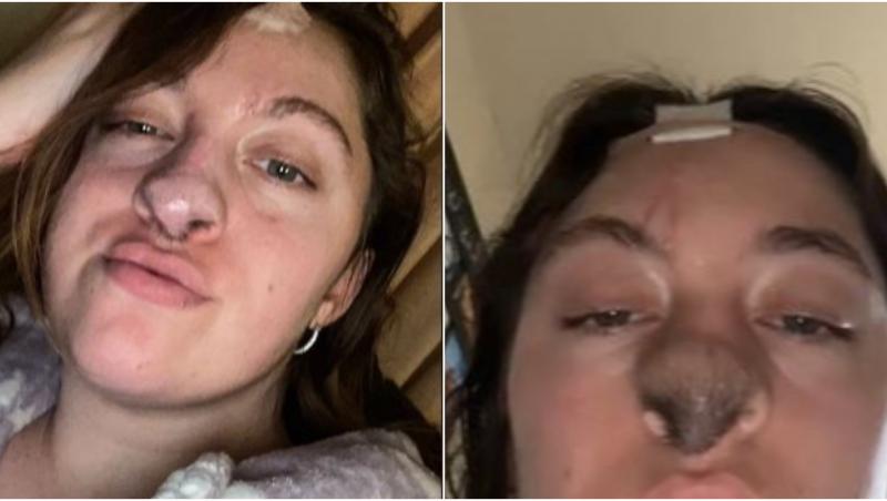 O tânără a observat cum nasul începe să ia o formă neobișnuită, după o intervenție medicală. Ce a urmat