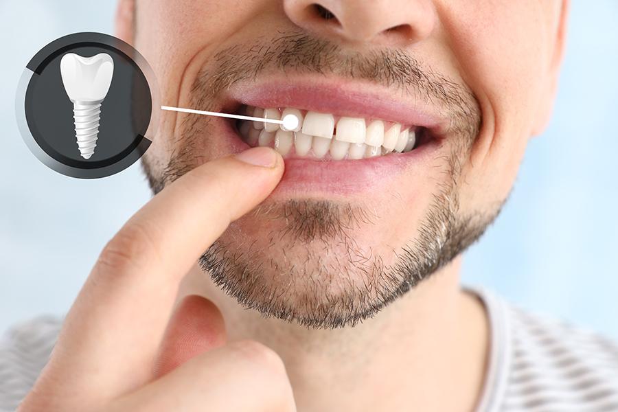 (P) Mituri și adevăruri despre implanturile dentare