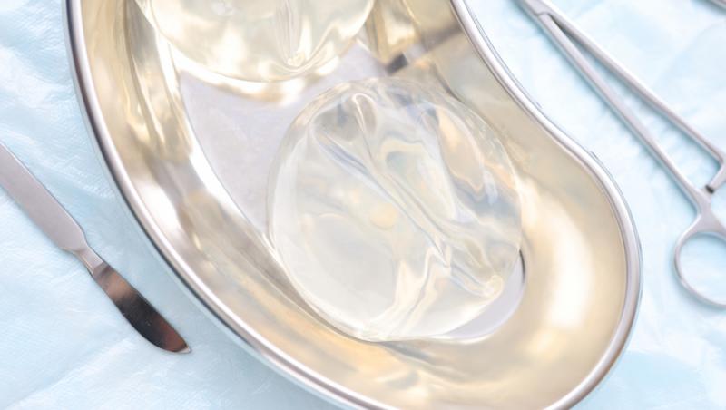 Ce a descoperit un doctor atunci când a scos un implant mamar de silicon, vechi de 23 de ani. A filmat totul