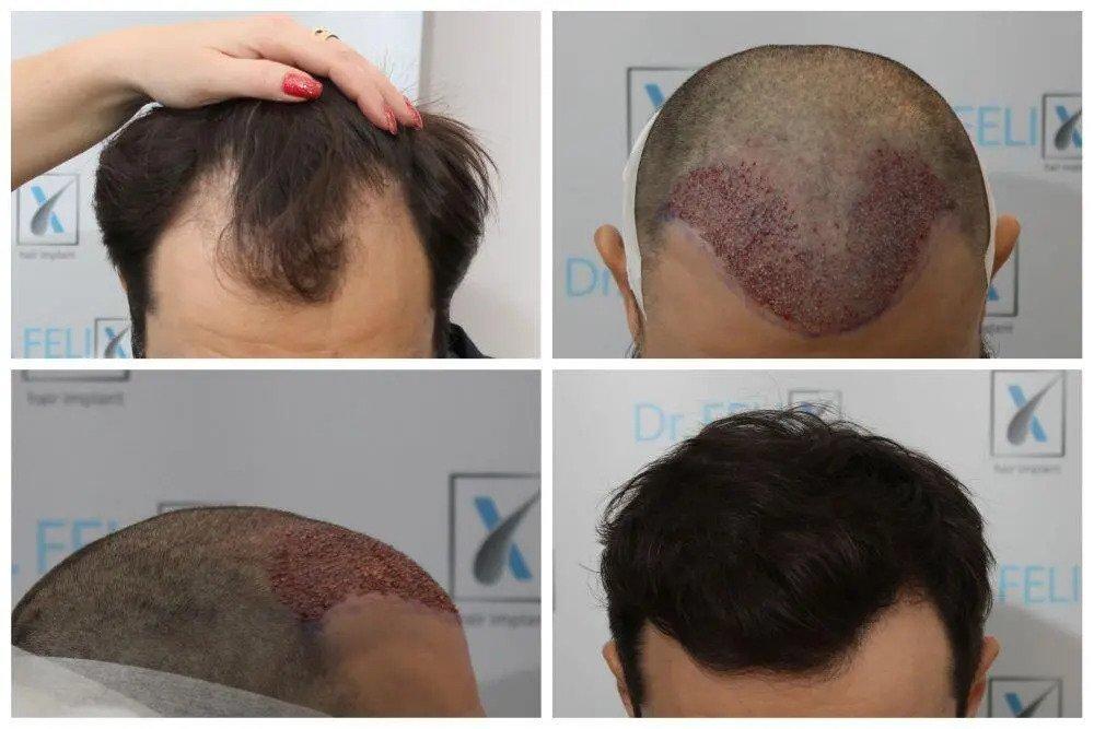 (P) Implant de păr și barbă la Dr. Felix Hair Implant
