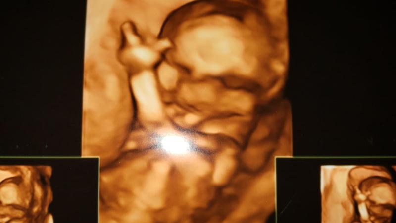 O mamă a privit ecografia bebelușului său și nu i-a venit să creadă ce apare în imagine. Ce a descoperit