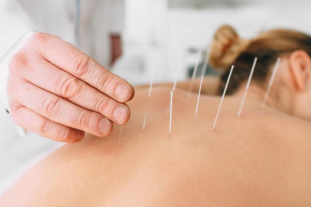 (P) Acupunctura ca modalitate de tratament alternativ pentru diverse afecțiuni!