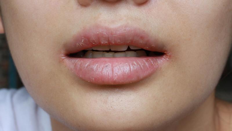Cele cinci boli grave pe care le poate semnala o gură uscată. La ce să fii atent dacă senzația de uscăciune persistă