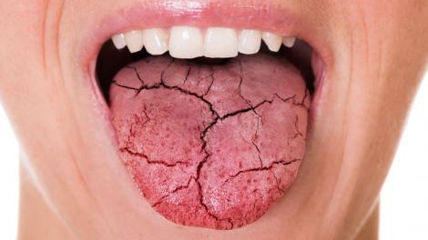 Cele cinci boli grave pe care le poate semnala o gură uscată. La ce să fii atent dacă senzația de uscăciune persistă