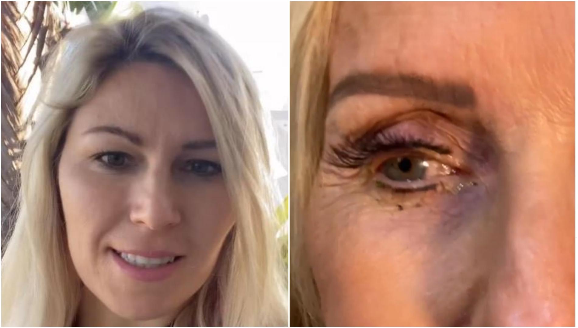 O femeie care folosea lentile de contact a mers la doctor pentru că simțea ceva în ochi. Oftalmologul, oripilat când a văzut cauza