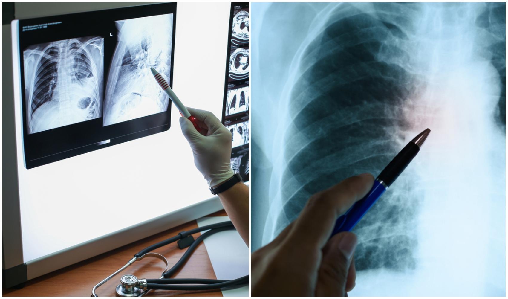 Un bărbat a făcut o radiografie și medicii au crezut că nu văd bine. Ce avea omul într-un plămân, de 5 ani, fără să știe