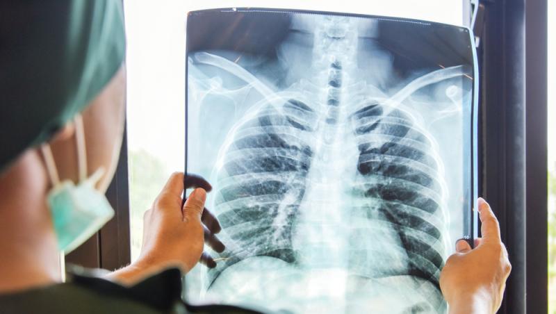 Un bărbat a făcut o radiografie și medicii au crezut că nu văd bine. Ce avea omul într-un plămân, de 5 ani, fără să știe