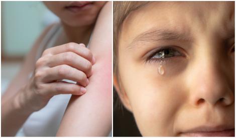 O fetiță de 11 ani este alergică la lacrimi și transpirație. Cum se transformă pielea ei când e atinsă de o simplă lacrimă
