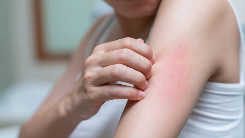 imagine cu o fata cu alergie sau eczema