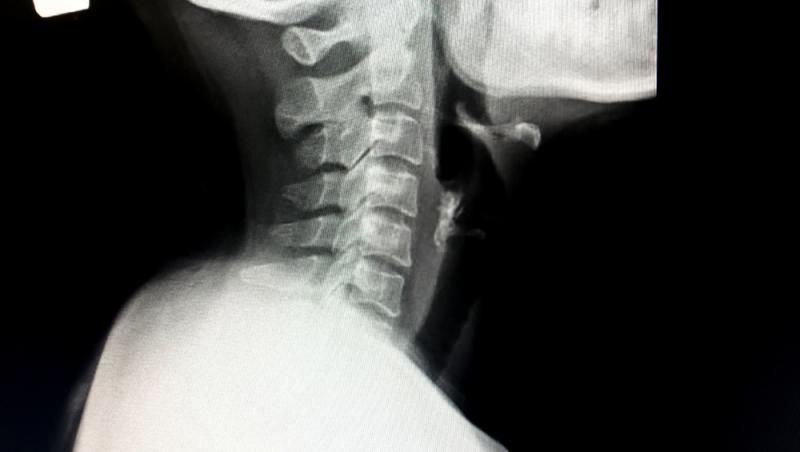 O femeie a mers la spital crezând că a i-a rămas un os blocat în gât. Ce au descoperit, de fapt, medicii
