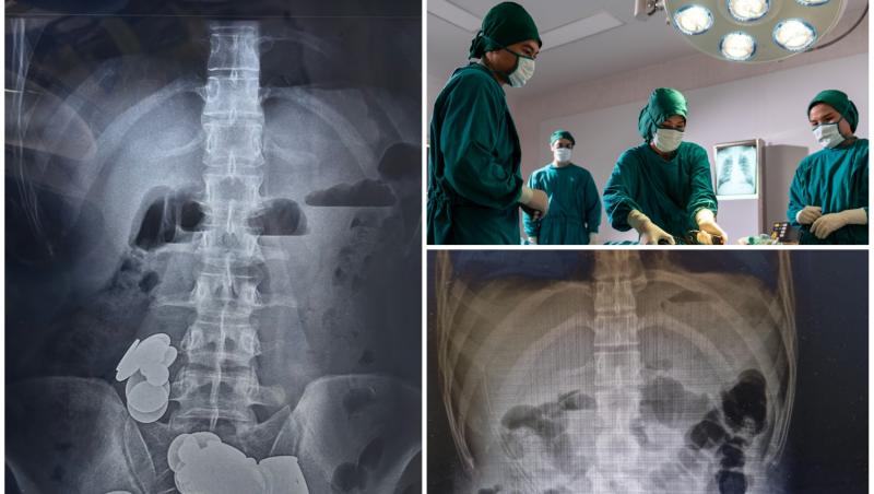 colaj foto cu radiografia unui pacient si poza cu medici in sala de operatie