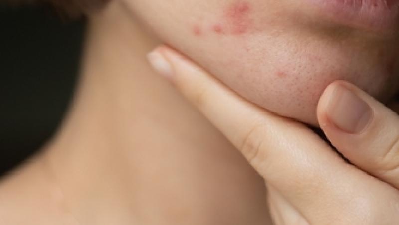 O substanță cancerigenă a fost identificată în tratamentele pentru acnee! Lista cu produsele care făceau minuni