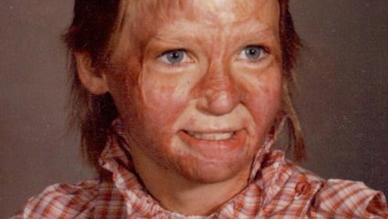 A renăscut din propria cenușă. Cum arată  acum femeia care a devenit Miss, după ce a suferit arsuri de gradul 3 pe 70% din corp