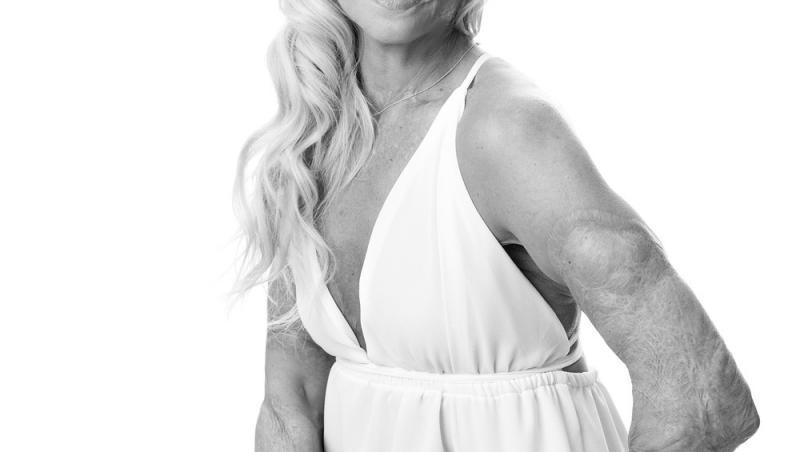 A renăscut din propria cenușă. Cum arată  acum femeia care a devenit Miss, după ce a suferit arsuri de gradul 3 pe 70% din corp