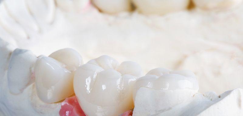 (P) Coroane dentare la Dent Priority: aspect natural și rezistență îndelungată