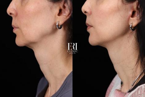 (P) Lifting facial și de gât, intervenții estetice la Eri Clinic care redau tinerețea și încrederea în tine