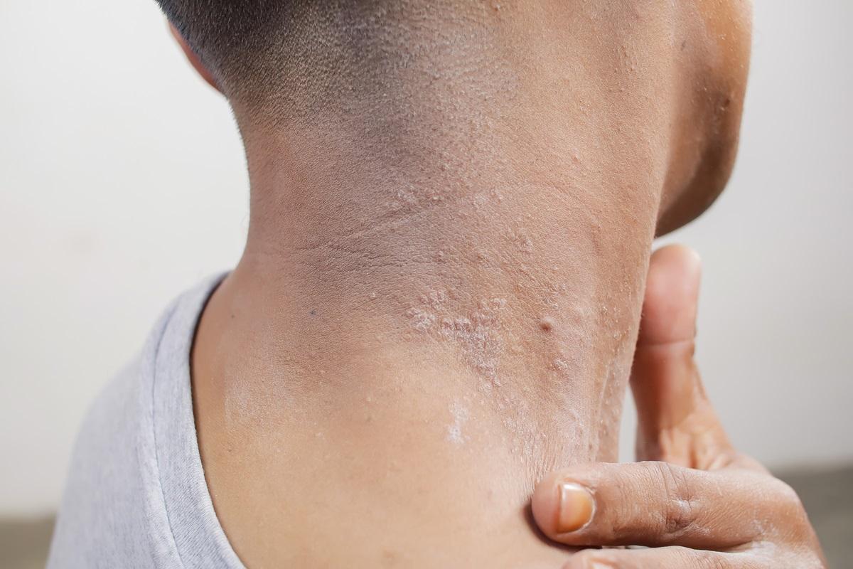 O „super ciupercă” rezistentă la medicamente se răspândește în Marea Britanie. Ce zone ale corpului afectează