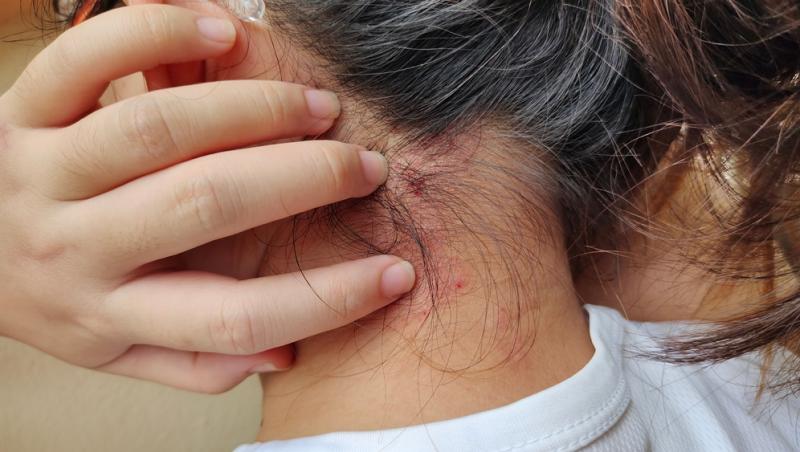 S-a confirmat primul caz de lepră în România după 44 de ani! Încă 3 suspiciuni se aplică în cazul unor maseuze asiatice din Cluj