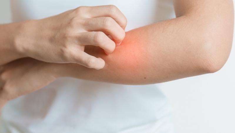 S-a confirmat primul caz de lepră în România după 44 de ani! Încă 3 suspiciuni se aplică în cazul unor maseuze asiatice din Cluj