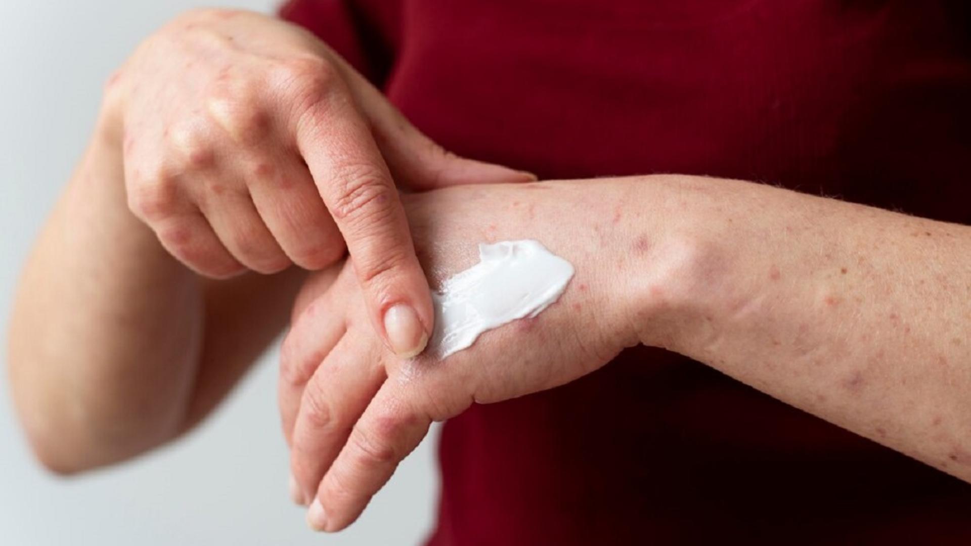 (P) Cauți tratament pentru psoriazis? 5 motive ca să testezi terapia pe bază de imunoglobulina Y de tip aviar