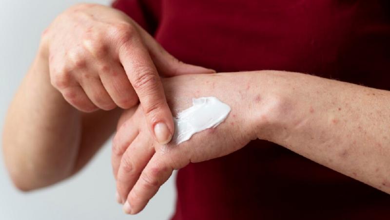 (p) Tratament pentru psoriazis. 5 motive pentru care să testezi terapia pe bază de imunoglobulina Y de tip aviar