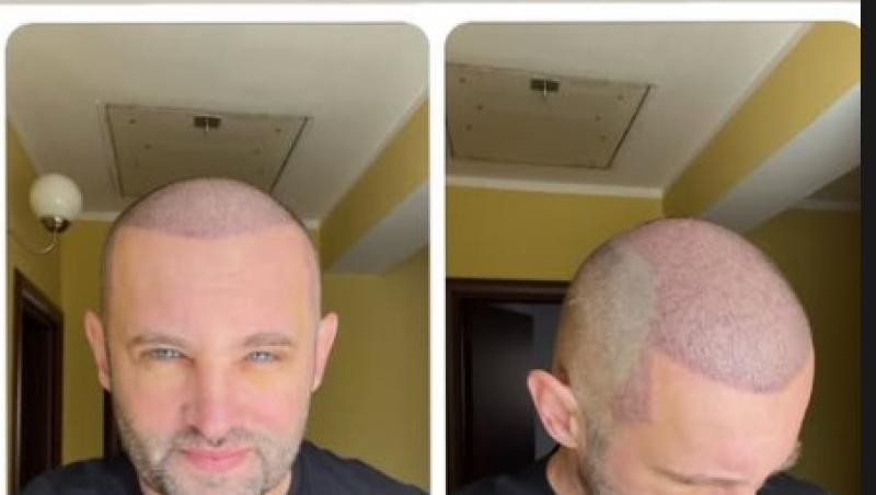 Sorin Brotnei a suferit o intervenție estetică. De ce nu mai vrea să iasă din casă