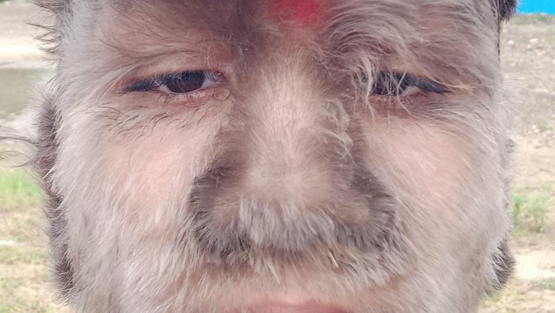 Tânărul care a intrat în Cartea Recordurilor pentru „cea mai păroasă față din lume”. De ce afecțiune rară suferă