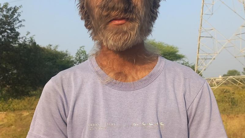 Tânărul care a intrat în Cartea Recordurilor pentru „cea mai păroasă față din lume”. De ce afecțiune rară suferă