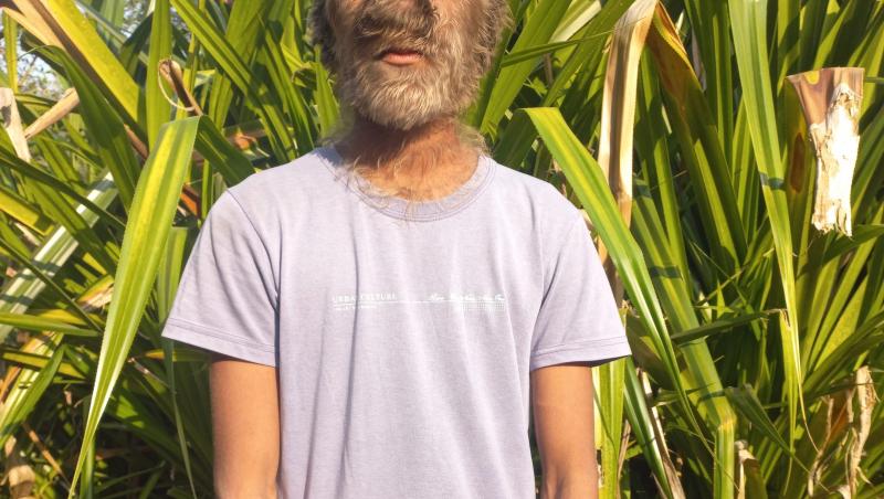 Tânărul care a intrat în Cartea Recordurilor pentru „cea mai păroasă față din lume”. De ce afecțiune rară suferă