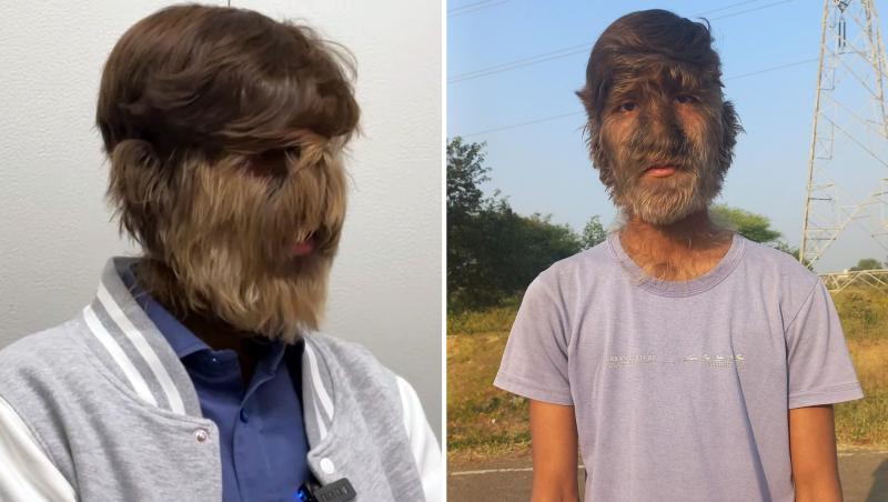 Tânărul care a intrat în Cartea Recordurilor pentru „cea mai păroasă față din lume”. De ce afecțiune rară suferă